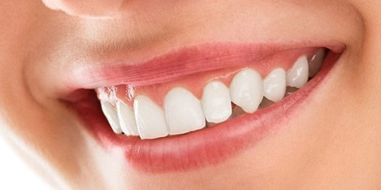 Hollywood Smile Makeovers in Dubai